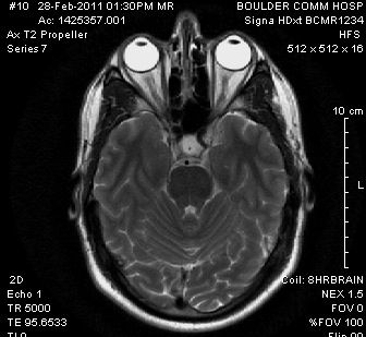 MRI results while trying (unsuccessfully) to identify a stroke